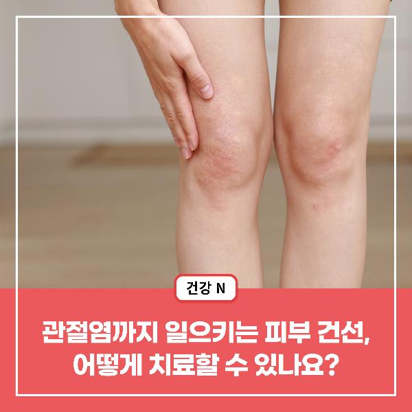 [건강N] 관절염까지 일으키는 피부 건선, 어떻게 치료할 수 있나요?