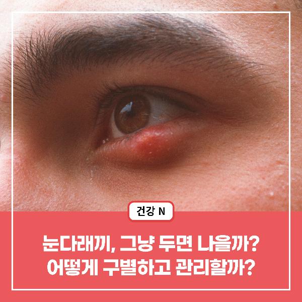 [건강N] 눈다래끼, 그냥 두면 나을까? 어떻게 구별하고 관리할까?